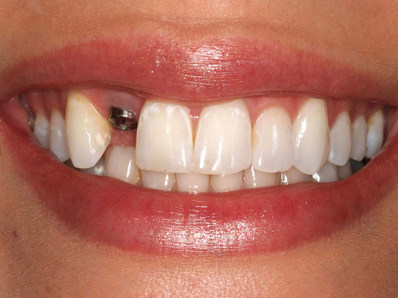 Рекомендации в период восстановления после имплантации зубов